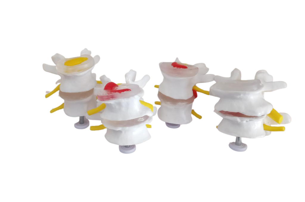 Vértebras lumbares 4 etapas combinación de modelos normales y patológicos
